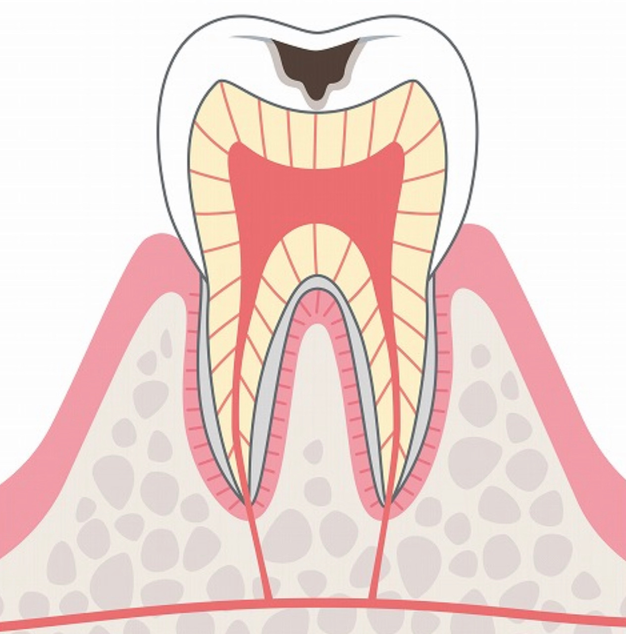 C2の虫歯の画像